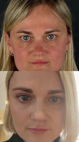 before-after photo upper-and-lower-eyelid-surgery