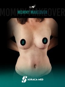 before-after photo reconstructive-breast-surgery