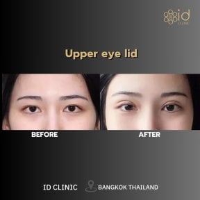 before-after photo lipofiling-molocnyh-zelez