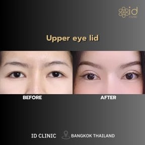 before-after photo lipofiling-molocnyh-zelez