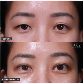 before-after photo upper-eyelid-surgery