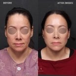 Результаты подтяжки лица до и после в VG Plastic Surgery, омоложение через 2 недели
