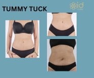 Результаты до и после абдоминопластики в ID Clinic Bangkok, улучшение контура живота