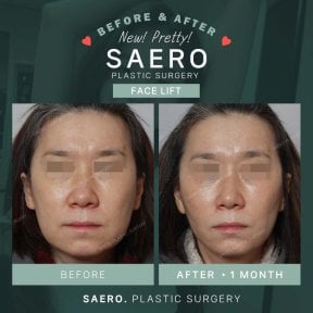 Before and after facelift results at SAERO Plastic Surgery, visible facial rejuvenation