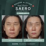 Before and after facelift results at SAERO Plastic Surgery, visible facial rejuvenation