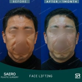 Before and after face lifting results at SAERO Plastic Surgery, visible facial rejuvenation