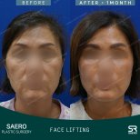Результаты до и после фейслифтинга в SAERO Plastic Surgery, видимое омоложение лица