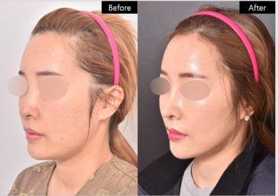 Результат до та після ниткового ліфтингу у VG Plastic Surgery – покращення контуру обличчя