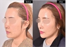 Результат до та після ниткового ліфтингу у VG Plastic Surgery – покращення контуру обличчя