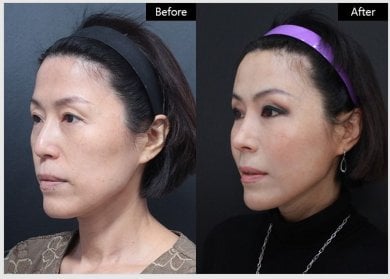 Результати ниткового ліфтингу до і після у VG Plastic Surgery – покращення контуру обличчя
