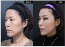 Результати ниткового ліфтингу до і після у VG Plastic Surgery – покращення контуру обличчя
