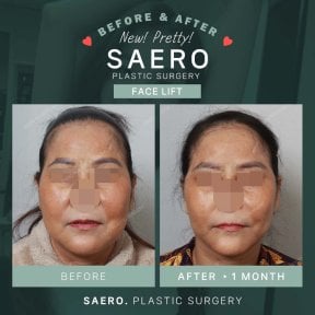 Результаты до и после подтяжки лица в SAERO Plastic Surgery, омоложение через 1 месяц