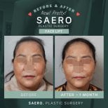Результаты до и после подтяжки лица в SAERO Plastic Surgery, омоложение через 1 месяц