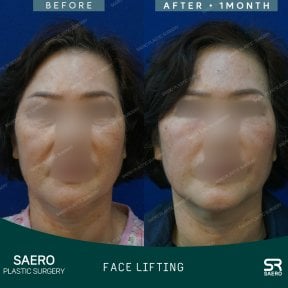 Результаты до и после фейслифтинга в SAERO Plastic Surgery, видимое омоложение лица