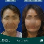 Результаты до и после фейслифтинга в SAERO Plastic Surgery, улучшение контура лица