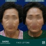 Результаты до и после фейслифтинга в SAERO Plastic Surgery, видимое омоложение лица