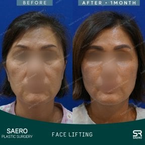 Результаты до и после фейслифтинга в SAERO Plastic Surgery, улучшение контура лица