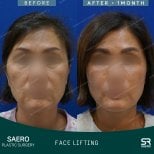 Результаты до и после фейслифтинга в SAERO Plastic Surgery, улучшение контура лица
