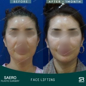 Результаты до и после фейслифтинга в SAERO Plastic Surgery, улучшение контура лица