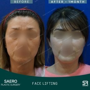 Результаты до и после фейслифтинга в SAERO Plastic Surgery, улучшение контура лица