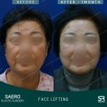 Результаты до и после фейслифтинга в SAERO Plastic Surgery, видимое омоложение лица