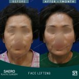 Before and after face lifting results at SAERO Plastic Surgery, visible facial rejuvenation