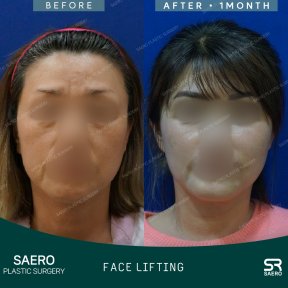 Результаты до и после фейслифтинга в SAERO Plastic Surgery, видимое омоложение лица