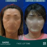 Результаты до и после фейслифтинга в SAERO Plastic Surgery, видимое омоложение лица