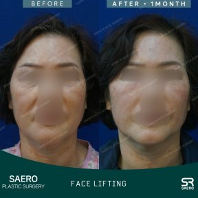 Результаты до и после фейслифтинга в SAERO Plastic Surgery, видимое омоложение лица