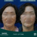 Результаты до и после фейслифтинга в SAERO Plastic Surgery, видимое омоложение лица
