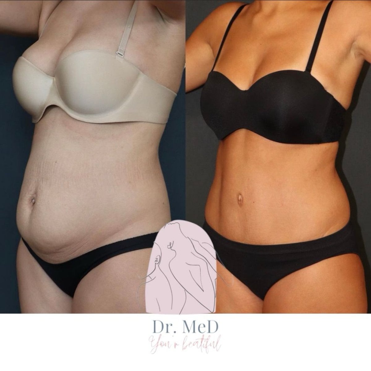 نتائج شفط الدهون قبل وبعد في Dr. MED – تحسين واضح في شكل البطن