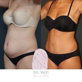 before-after photo liposuction