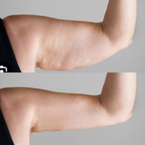 before-after photo liposakciya