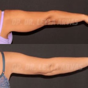 before-after photo liposakciya