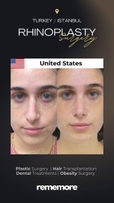before-after photo rhinoplasty-nose-job