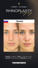 before-after photo rhinoplasty-nose-job