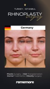before-after photo rhinoplasty-nose-job