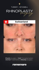 before-after photo rhinoplasty-nose-job