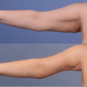 before-after photo plastika-ruk-brahioplastika