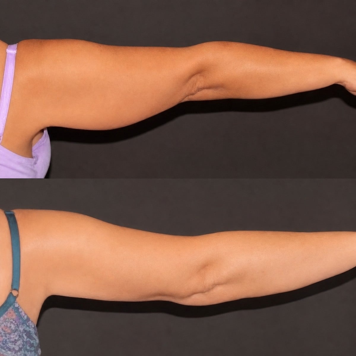 Resultados de lifting de brazos antes y después en Hisar Hospital Intercontinental