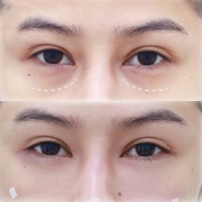 Resultados antes y después de rellenos bajo los ojos – menos ojeras y piel más suave