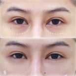 Resultados antes y después de rellenos bajo los ojos – menos ojeras y piel más suave