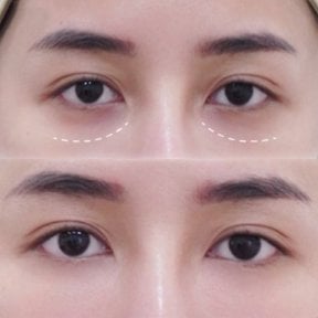 Résultats avant/après injections de fillers sous les yeux – cernes réduits, peau lissée