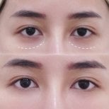 Résultats avant/après injections de fillers sous les yeux – cernes réduits, peau lissée