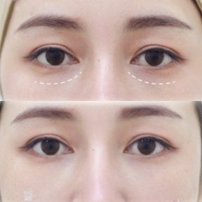 Before and after fillers injection under eyes, visible reduction of dark circles and hollows