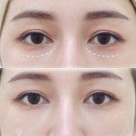 Before and after fillers injection under eyes, visible reduction of dark circles and hollows