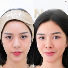 before-after photo inekcii-fillerov