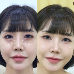 before-after photo inekcii-fillerov