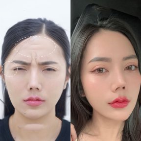 before-after photo botoks-ot-morshchin