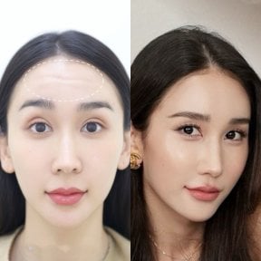 before-after photo botoks-ot-morshchin